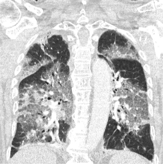 De betreffende longen